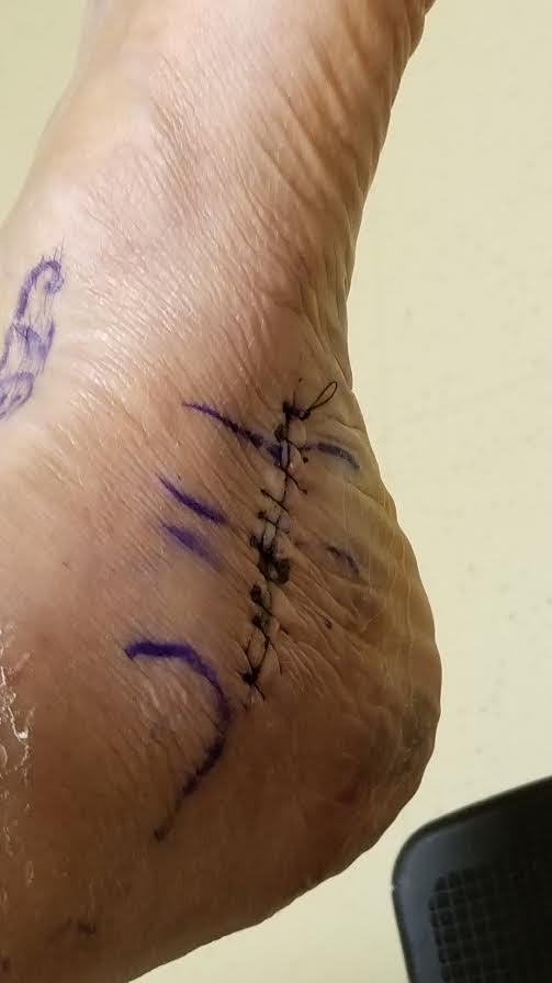 foot post surgery
